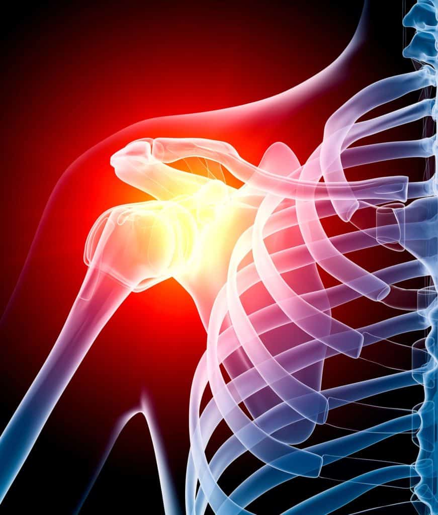 Shoulder Pain